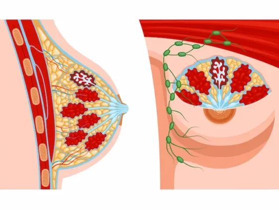 Fibroadénome : comprendre cette tumeur bénigne du sein